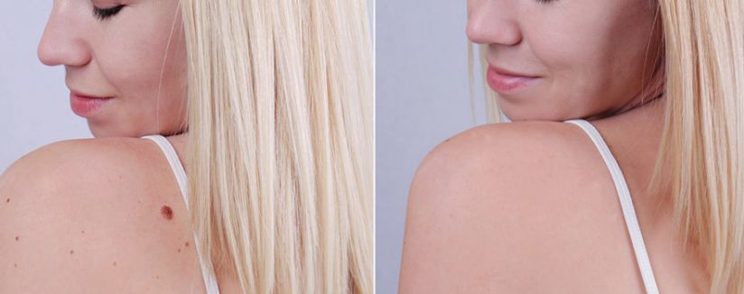 Before & After